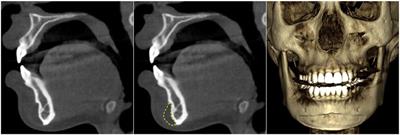 Mandibular Bone Resorption Following Chin Augmentation: A Systematic Review